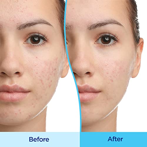 Differin Acne Treatment Gel, 30 Day Supply, Retinoid Treatment for Face