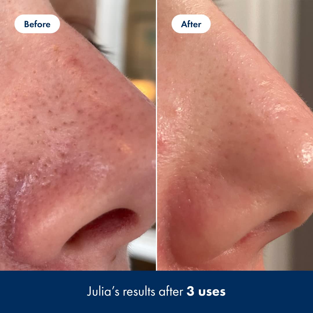 Hero Cosmetics Pore Release Blackhead Clearing Solution - Exfoliating Toner Featuring BHA