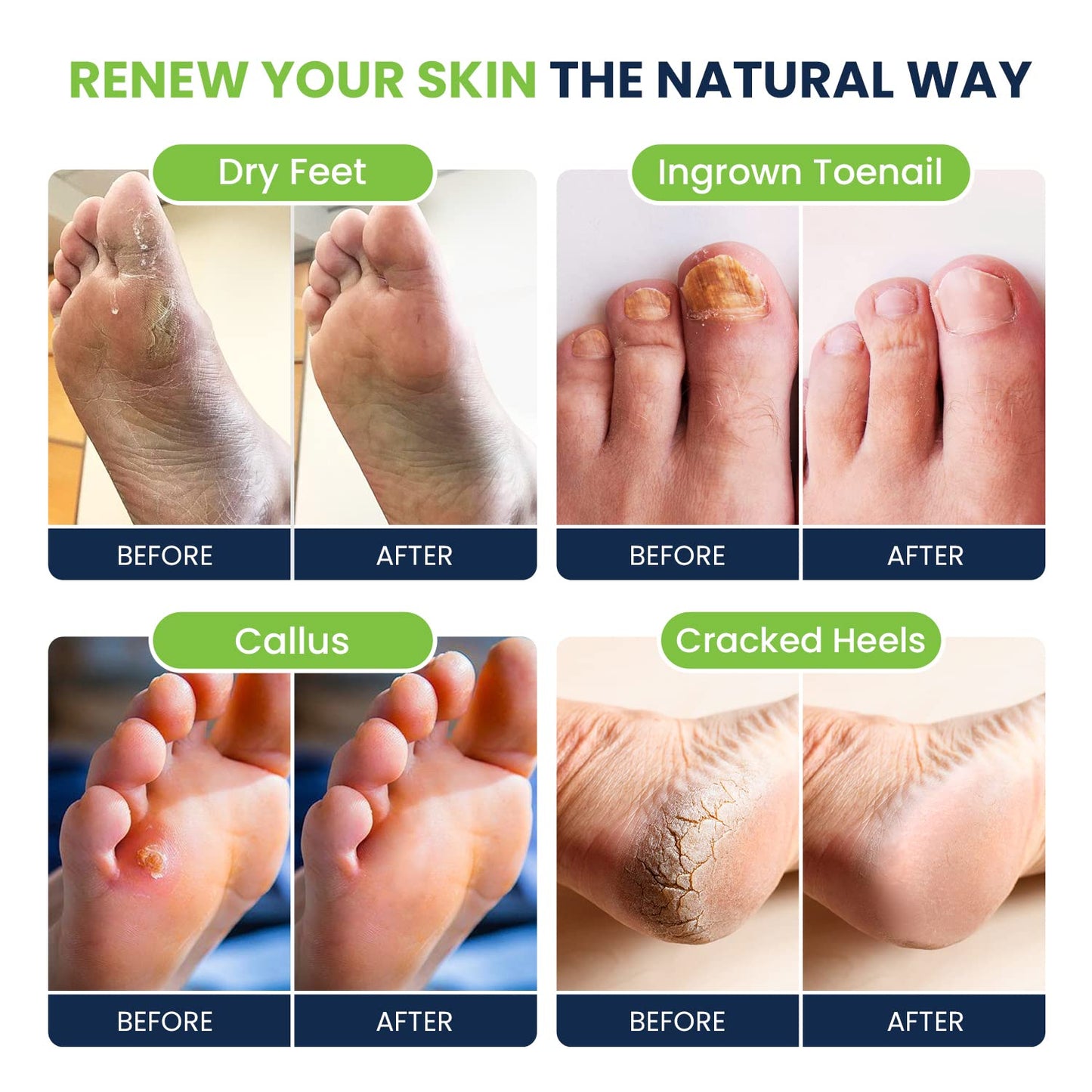 Foot Soak with Epsom Salts- Variety Pack of 4- Tea Tree Oil, Muscle Relief, Calming