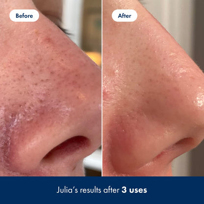 Hero Cosmetics Pore Release Blackhead Clearing Solution - Exfoliating Toner Featuring BHA