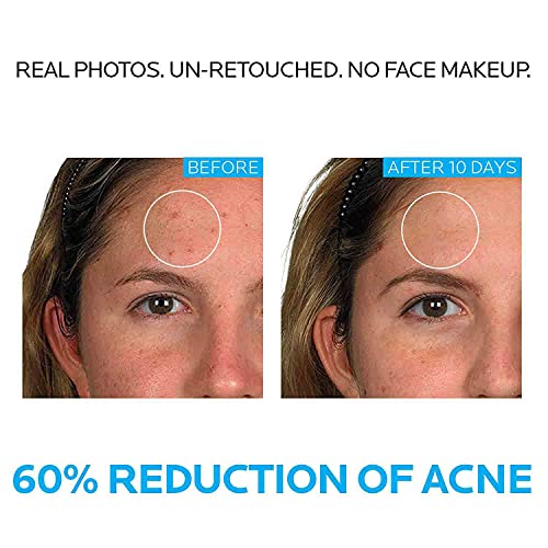 La Roche-Posay Effaclar Dermatological 3 Step Acne Treatment System