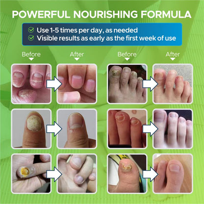 Toenail Fungus Treatment Extra Strength - Fungal Nail Treatment for Toe Nail & Fingernails