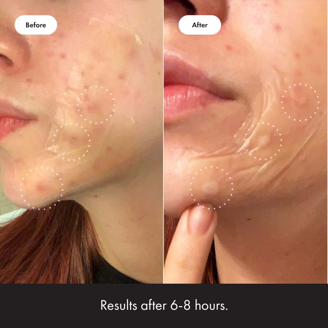 Mighty Patch™ Surface patch from Hero Cosmetics - Hydrocolloid Spot Patch for Body Mighty Patch