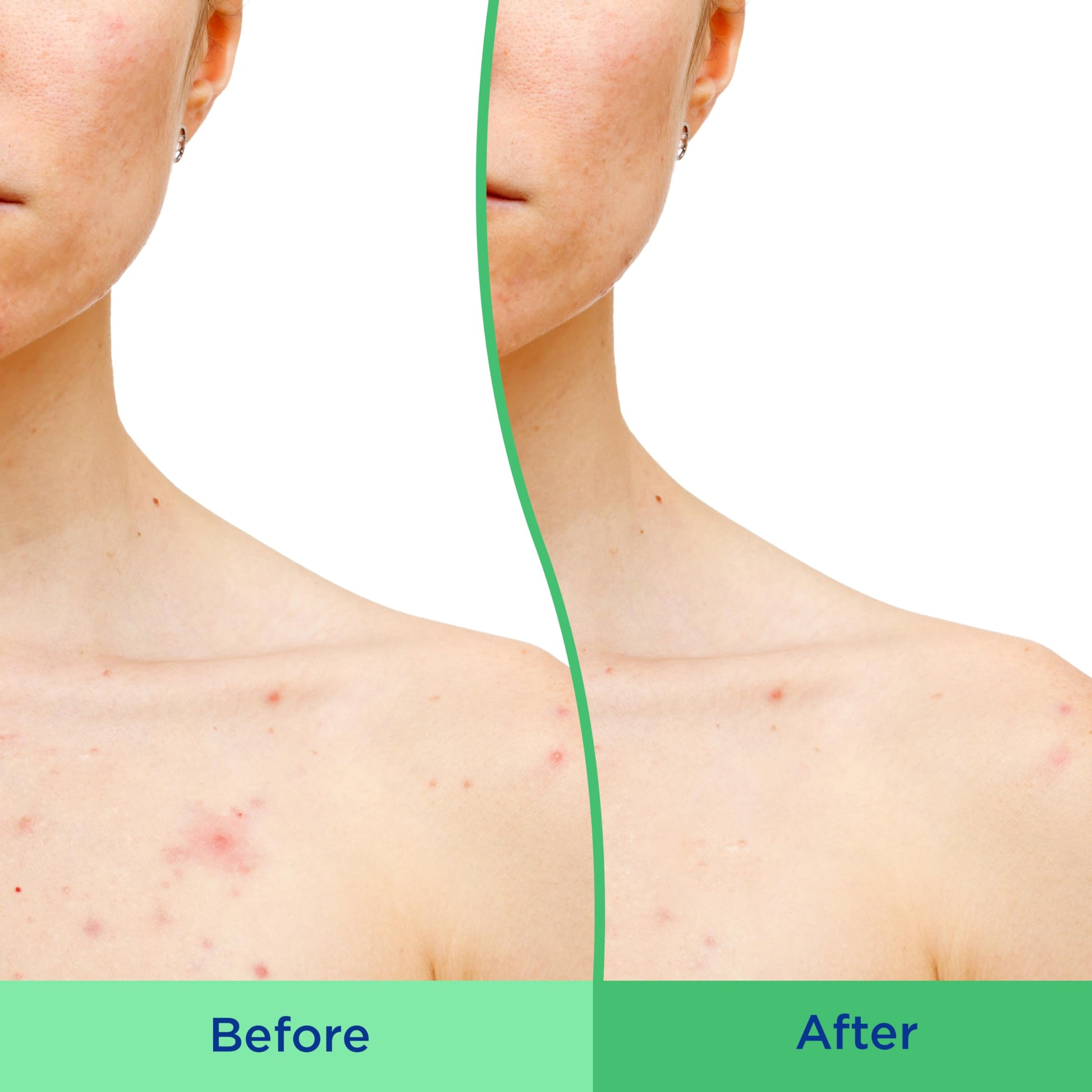 Differin Body Scrub with Salicylic Acid Acne Clearing Improves Tone and Texture Prone Skin Differin