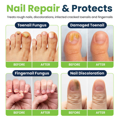Toenail Fungus Treatment Extra Strength - Fungal Nail Treatment for Toe Nail & Fingernails