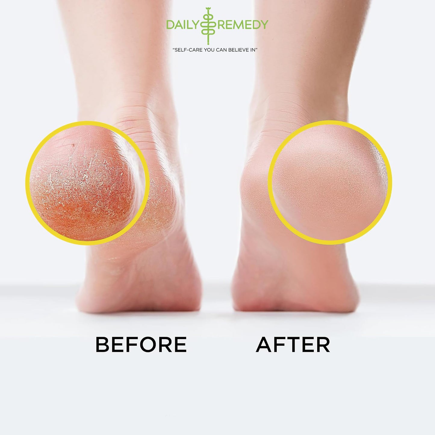 Citrus Detox Foot Soak with Epsom Salt - for Foot Callus, Immune Boost, Damaged Toenail