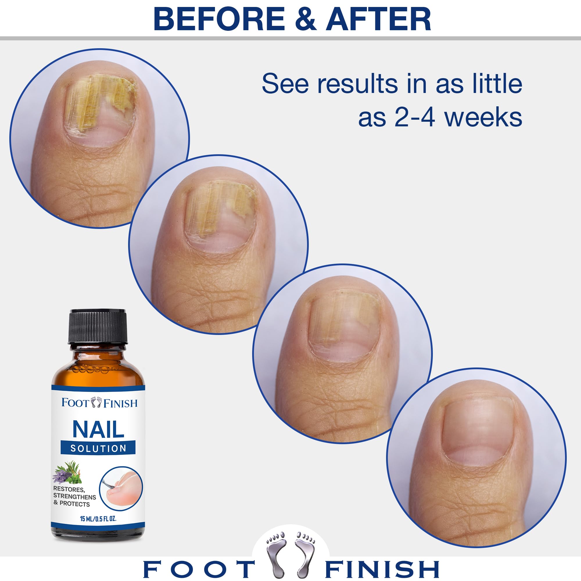 LOVE, LORI Tea Tree Oil for Toenail Fungus Treatment Extra Strength (15ml) - Nail Repair