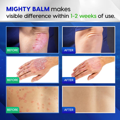 Tobcharm Antifungal Cream, Antifungal Cream for Skin, Ringworm Treatment for Humans